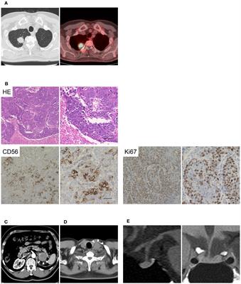 Paraneoplastic isolated adrenocorticotropic hormone deficiency revealed after immune checkpoint inhibitors therapy: new insights into anti-corticotroph antibody